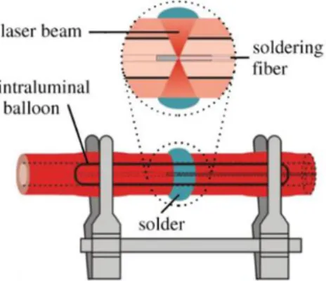 Figure 6. Schematics of the laser-assisted vessel soldering [51]. 
