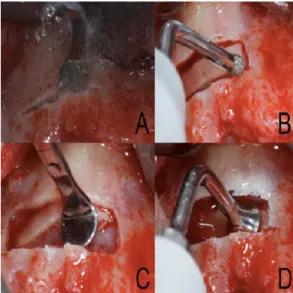 Figura 16 - A janela de acesso ósseo é preparada com pontas de corte diamantadas para tecido ósseo     (A, B), e a membrana do seio é elevada com pontas de descolamento de tecido mole (C,D)                    