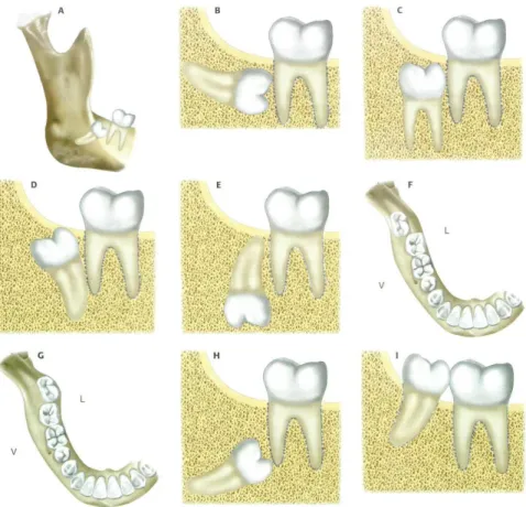 Figura 13 – Posições do terceiro molar inferior. 2   