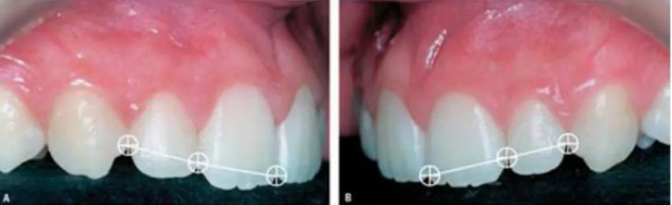 Figura 14 – Contactos, conectores e ameias em dentes ântero-superiores  Fonte: Fradeani 2006 