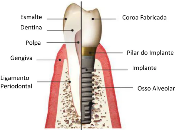 Figura 1 - Comparação entre um dente natural e um implante com coroa (adaptado de Zhang &amp; Zheng,  2015) 