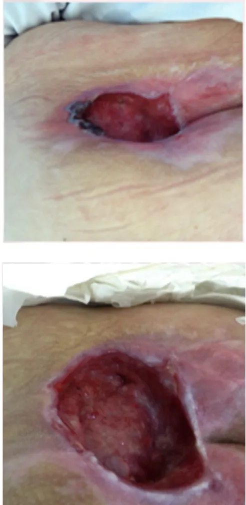 Tabela 2. Extensão da lesão no inicio e após  tratamento com Novasouce Proline  Local 