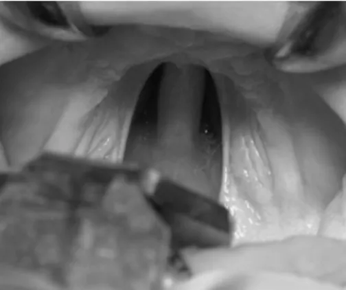 Figura 3. Esquerda –Posição de repouso da língua com o recém-nascido totalmente relaxado  antes da operação (distração); vias oral e nasal obstruídas; postura vertical da língua com a  maioria desta acima das lâminas palatinas
