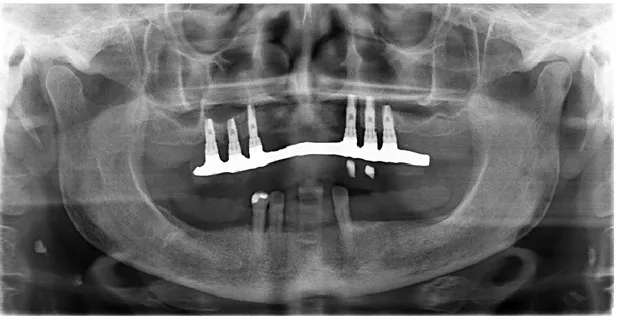 Figura  5  –  Ortopantomografia  realizada  na  Clínica  Universitária  Egas  Moniz  (CUEM),  em  2016  a  uma paciente do sexo feminino com 64 anos de idade,  na qual é possível visualizar várias calcificações  bilaterais da artéria carótida