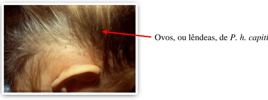 Fig 10- Ovos, ou lêndeas, de Pediculus humanus capitis numa criança com  pediculose da cabeça