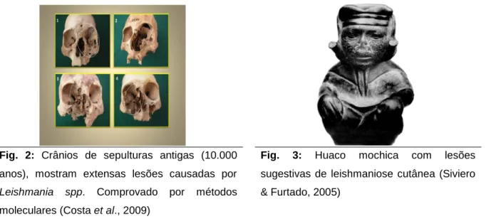 Fig.  3:  Huaco  mochica  com  lesões  sugestivas  de  leishmaniose  cutânea  (Siviero 
