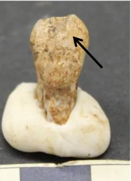 Figure 6 Chipping in the labial surface of tooth 23  unearthed from cist 2 of NCV. 