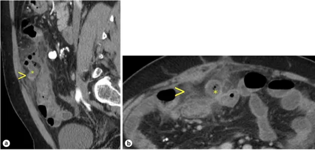 Fig. 1. a  Sagittal enhanced CT images showing a tubular blind-ending structure (asterisk) measuring 65 mm  (longitudinal diameter), with a thickened and hypercaptant wall (arrowhead)