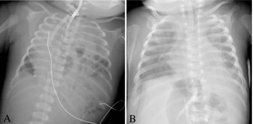 Figura 2. Radiografia de tórax do doente 2 pré-operatória (A); pós-operatória (B).
