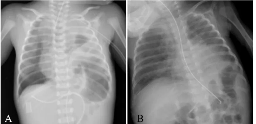 Figura 3. Radiografia de tórax do doente 3 pré-operatória (A); pós-operatória (B).