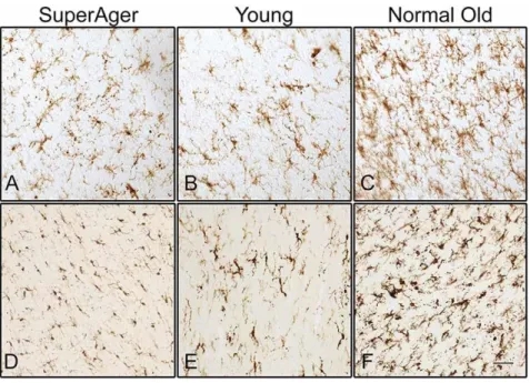Figure 2.3: Staining of activated microglia in the white matter of the inferior frontal gyrus (A, B, C) and in corpus callosum  (D, E, F)