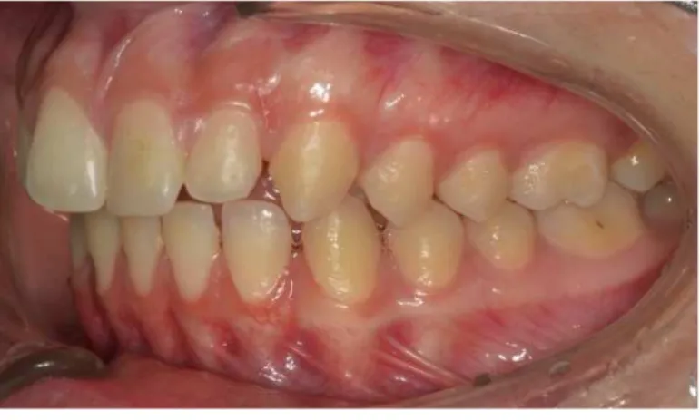 Figura 3 - Má oclusão Classe II canina e molar esquerda (Fotografia cedida pela consulta assistencial  de ortodontia da CDEM) 