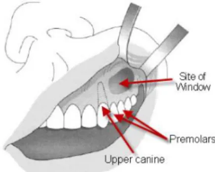 Figura 3. Procedimento de Cadwell-Luc a  mostrar a janela cirurgica para o seio maxilar  anterior 