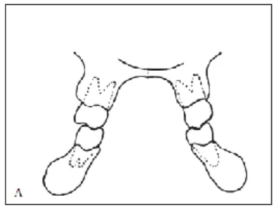 Figura 5 - Inclinação vestibular dos dentes maxilares e inclinação lingual dos dentes mandibulares, na  tentativa de compensar o desajuste esquelético 