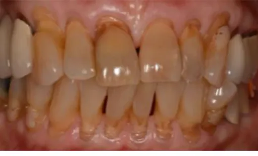 Figura 5: Paciente idoso com LCNC em toda a dentição e com um deficit estético ao sorrir (Nascimento  et al., 2016) 
