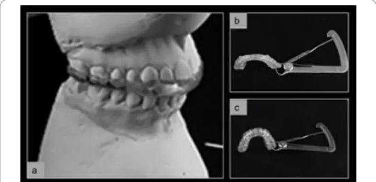 Figure 3: a: adjustment of the stabilizing splints in a semi-adjustable articulator b: 1mm occlusal splint 