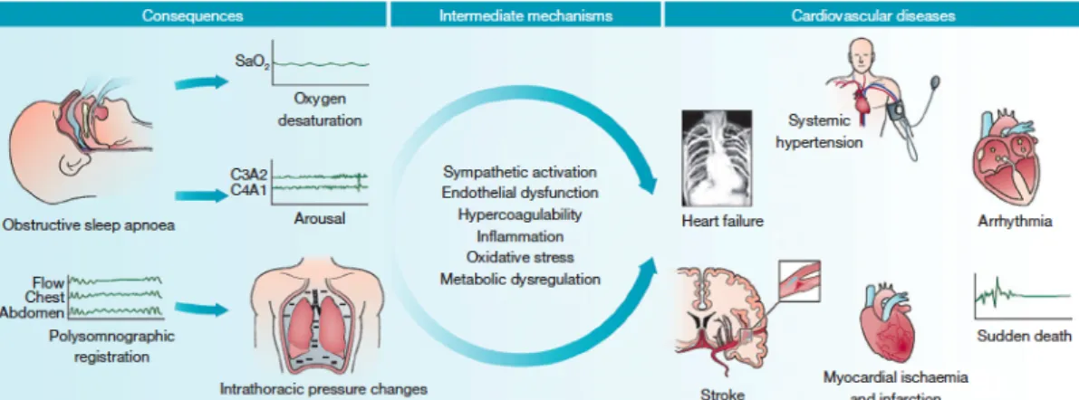 Figura 1. Pathological relationship between sleep apnea and cardiovascular disease. 