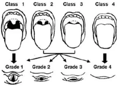 Figura 1: Índice de Mallapati. Classe 1: visibilidade total das amígdalas, úvula e palato  mole