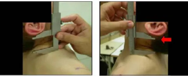 Fig. 1 – Avaliação da extensão da cabeça com compasso de corrediça [18]