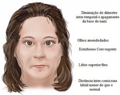 Figura 7: Alterações faciais em indivíduos com PWS [Adaptado de 