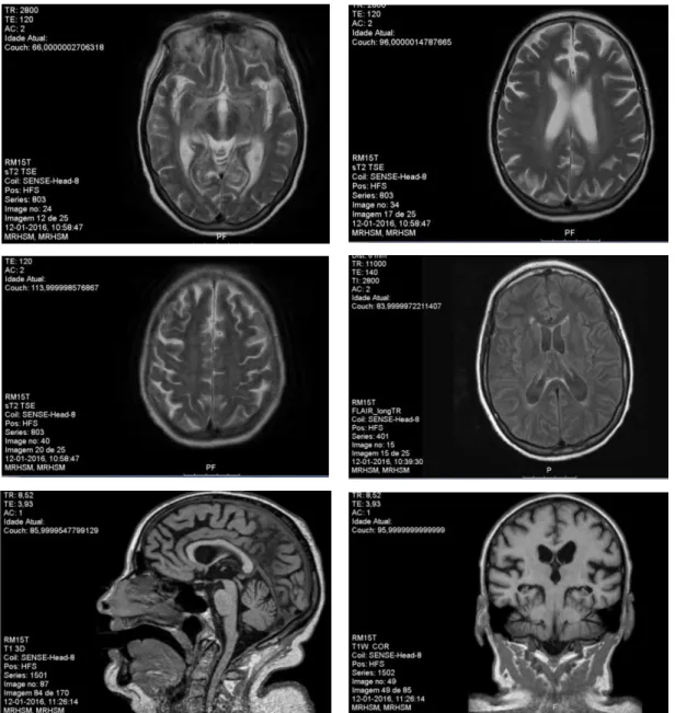 Figura 1. Imagens da RM realizada após alta da doente.  