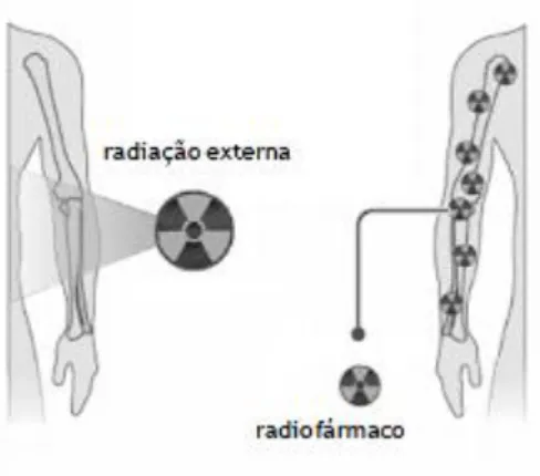 Figura 1.2 – Esquema da utilização de uma fonte externa de radiação em radioterapia (esquerda) e de um radiofármaco  (direita) em Medicina Nuclear