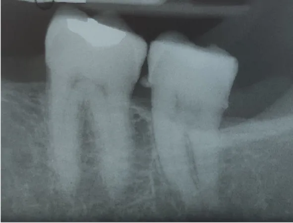 Figura 2 - Radiografia Periapical.  