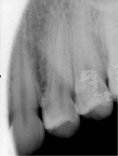 Figura 6 - Corte de Cone.  