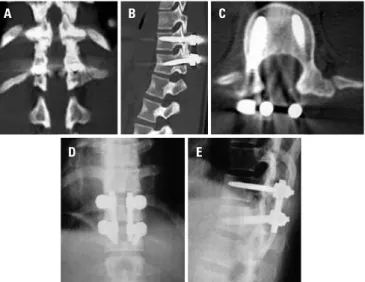 Figura 2. Ressonância magnética por imagem mostrando ruptura completa dos 