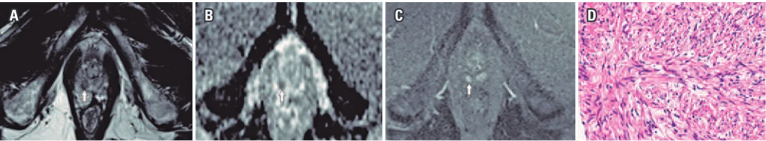 Figura 2. A ressonância magnética multiparamétrica da próstata mostra um nódulo circunscrito na zona periférica, nas imagens ponderadas em T2 (A), com 