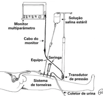 Figura 2. Técnica que utiliza o transdutor de pressão conectado a um sistema de  torneiras