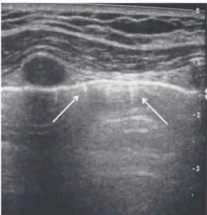 Figura 2. Linhas A representam reverberação da interface pleuropulmonar 