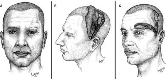 Figura 2. (A) Ausência de sobrancelha. (B) Representação esquemática de reconstrução de sobrancelha com retalho de 