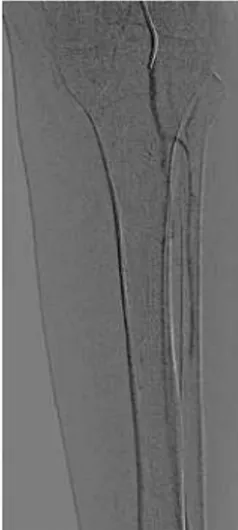 Figura 1. Arteriografia com dióxido de carbono. Artérias poplítea e fibular  pérvias, oclusão no terço médio da artéria tibial anterior