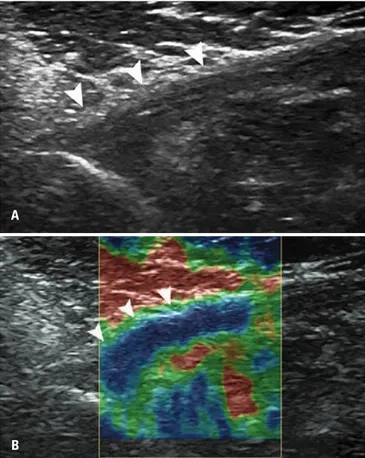 Figura 1. Avaliação ultrassonográfica de um tendão do peitoral maior normal. 