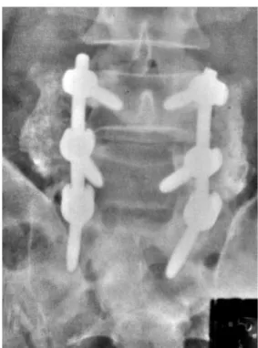 Figura 1. Radiografia anteroposterior da coluna lombossacra, na qual se observa 