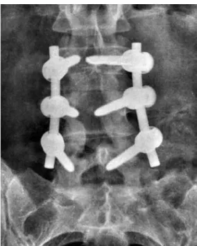 Figura 2. Radiografia anteroposterior da coluna lombossacra, na qual se observa 