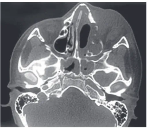 Figura 1. Tomografia computadorizada de seios da face. Sinais de persistência 