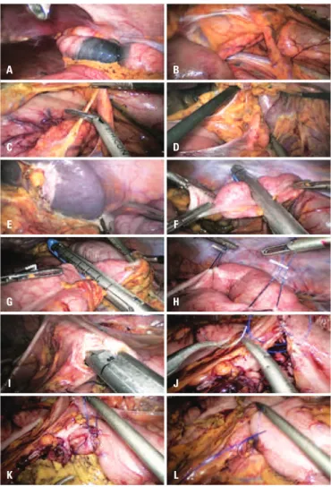 Figura 1. Colectomia total laparoscópica esquerda: passos propostos para  padronização