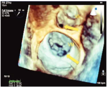 Figura 4. Ecocardiograma transesofágico tridimensional mostrando perfuração 