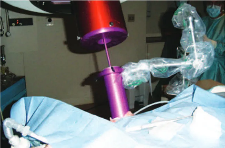 Figura 1. Radioterapia intraoperatória – o colimador, em lilás, está conectado ao  acelerador linear, adentrando a glândula mamária por meio do afastamento da  pele supratumoral