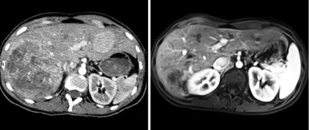 Figura 4. Tomografia de abdome pré-embolização e ressonância magnética de controle após 1 ano