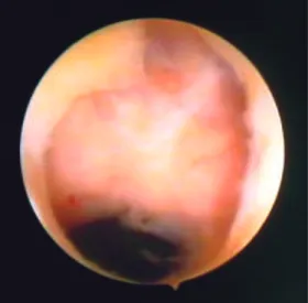Figura 1. Imagem histeroscópica de pseudodivertículo em cicatriz de cesárea