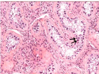 Figura 3. Carcinoma in situ (indicado pelas setas) na parênquima do testículo