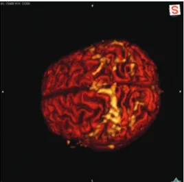 Figura 5. Exemplo de fusão de imagens resultante do trabalho: o cérebro pela  tomografia computadorizada, ressonância magnética estrutural e funcional