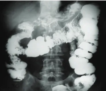 Figura 1. Imagem do trato digestório mostrando fístula duodenocólica (Caso 1).