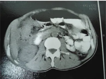 Figura 3. Tomografia computadorizada mostra um grande tumor heterogêneo na  flexura direita, que invade o fígado e a segunda porção do duodeno (Caso 3).