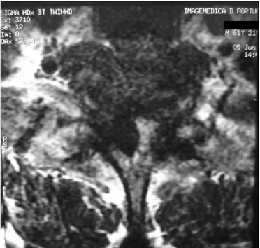 Figura 1B. A RMI axial apresentou compressão bilateral significativa da coluna  vertebral