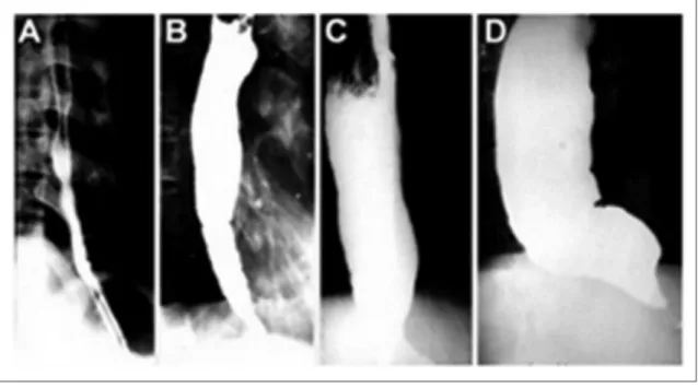 Figura 12 – Classificação radiológica do megaesôfago, em grupos