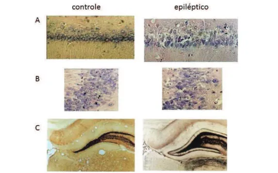 Figura 1 – Cortes coronais de hipocampo corados com violeta de cresila evidenciando  a perda celular nos subcampos de CA1 (A) e CA3 (B) de ratos submetidos  ao modelo da pilocarpina